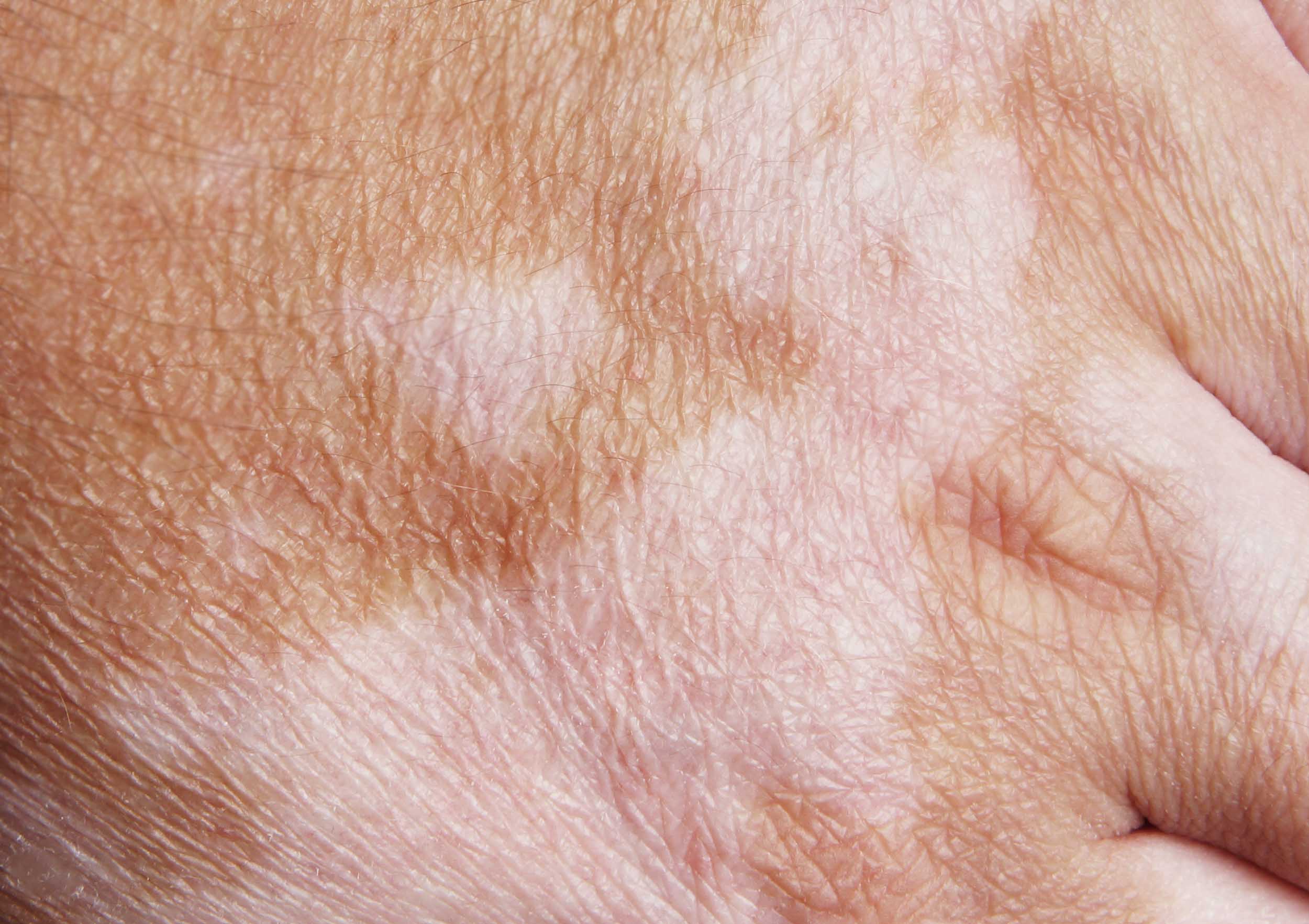 Copertura cicatrici vitiligine traumi operatori